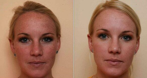 Laserbehandlung von Gesicht und Haut (fraktioniert und andere